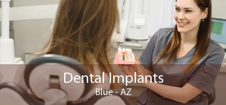Dental Implants Blue - AZ