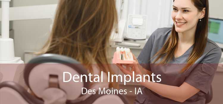 Dental Implants Des Moines - IA