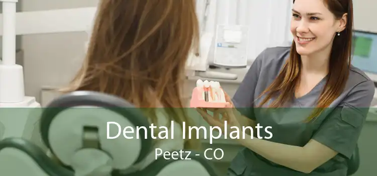 Dental Implants Peetz - CO