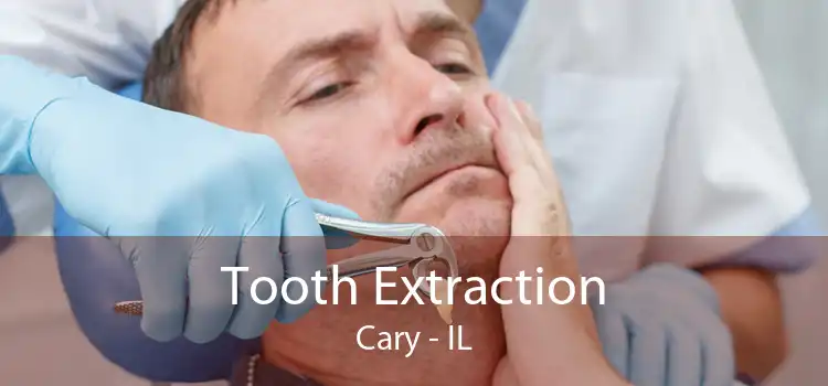 Tooth Extraction Cary - IL