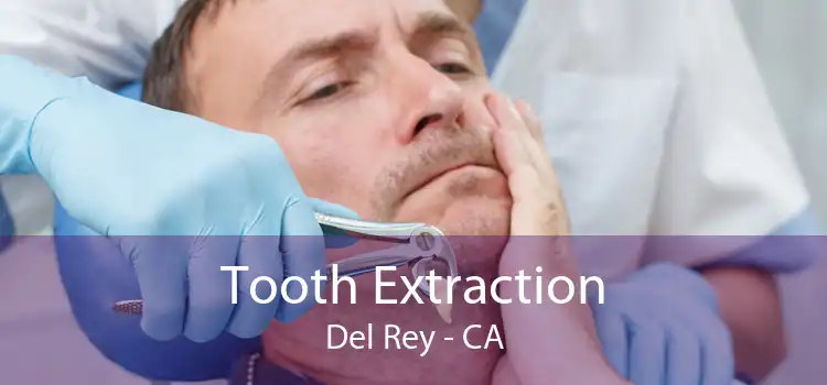 Tooth Extraction Del Rey - CA