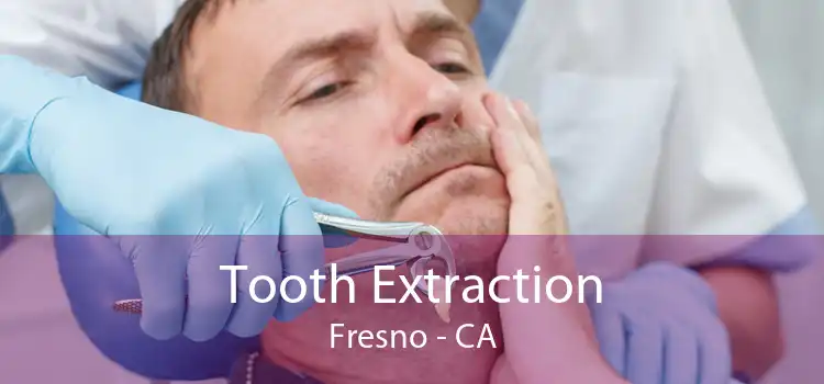 Tooth Extraction Fresno - CA