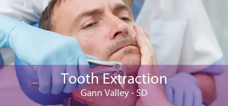 Tooth Extraction Gann Valley - SD
