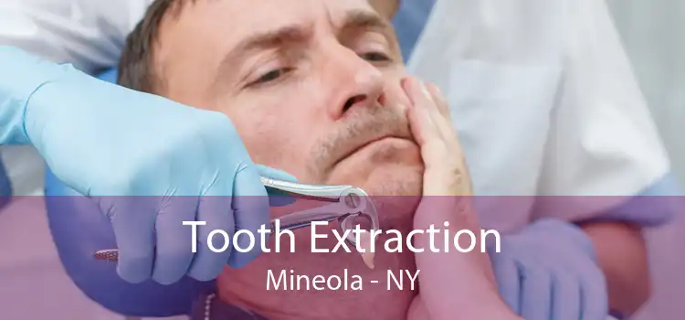 Tooth Extraction Mineola - NY