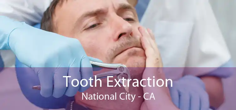 Tooth Extraction National City - CA
