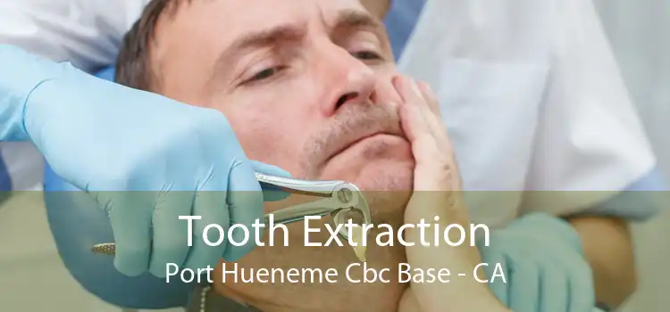 Tooth Extraction Port Hueneme Cbc Base - CA