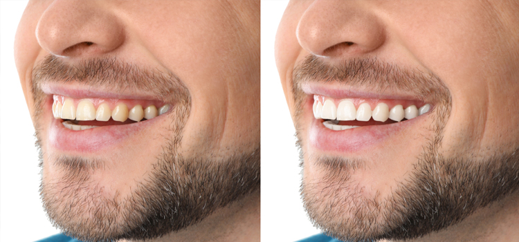 Natural Teeth Whitening in Albertson, NY