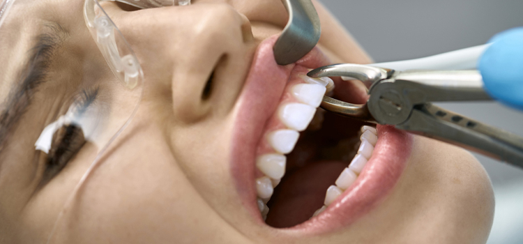 Tooth Extraction Cost in Woodstock, IL