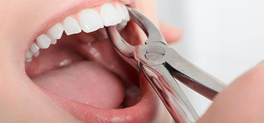 Tooth Extraction in Bessemer