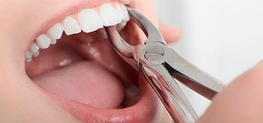 Tooth Extraction in Monroeville